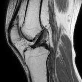 膝関節MRI