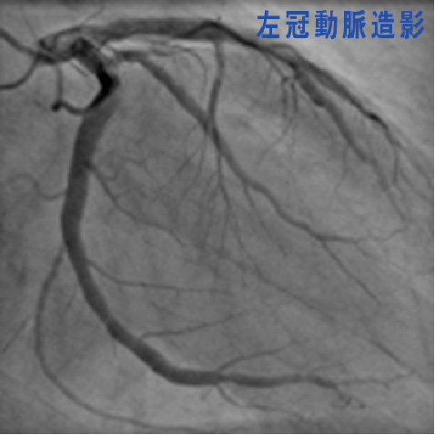 左冠動脈造影