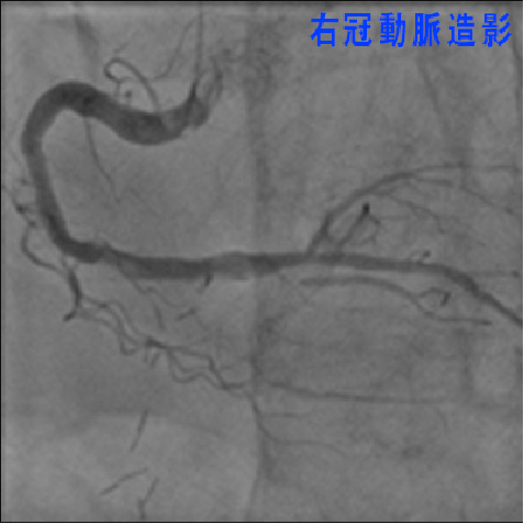 右冠動脈造影