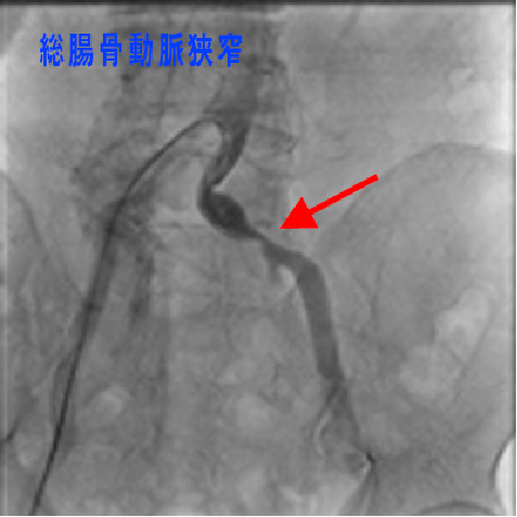 総腸骨動脈狭窄