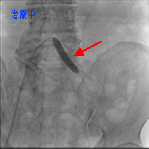 総腸骨動脈狭窄　治療中