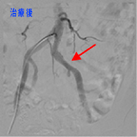 総腸骨動脈狭窄　治療後