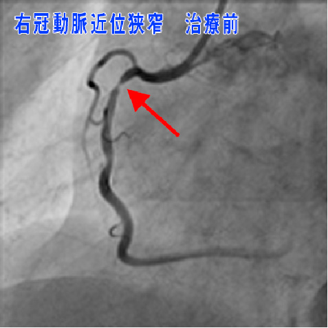 左冠動一脈位狭窄　治療前