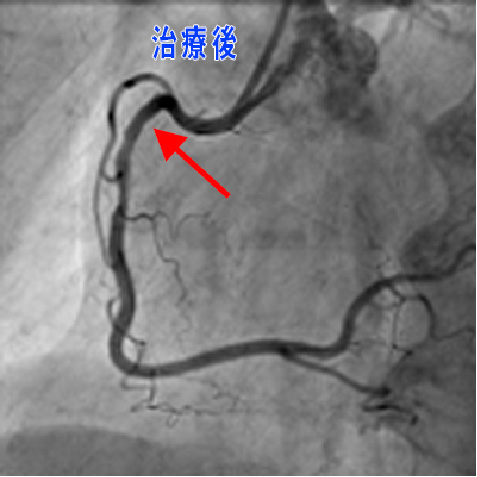 左冠動一脈位狭窄　治療後