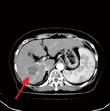 ③治療後　CT