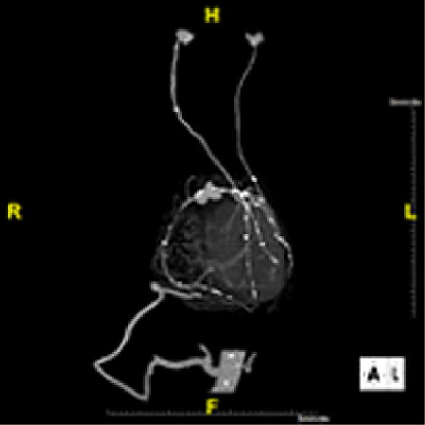 CABG 後冠動脈CT