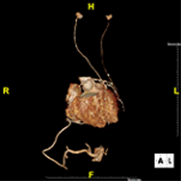 CABG 後冠動脈CT