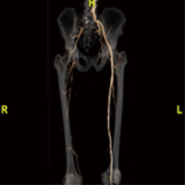 EVT 前後下肢動脈CT