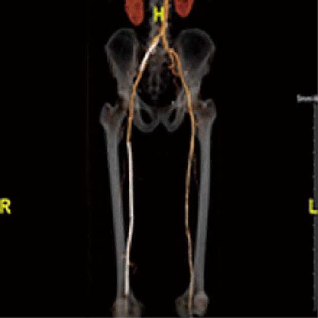 EVT 前後下肢動脈CT