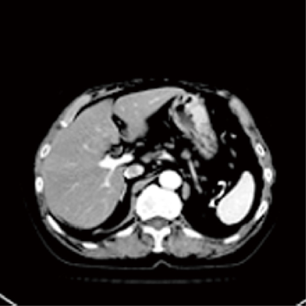 腹部CT　低管電圧（100Kv） 造影剤使用量（20％～ 30％減量）