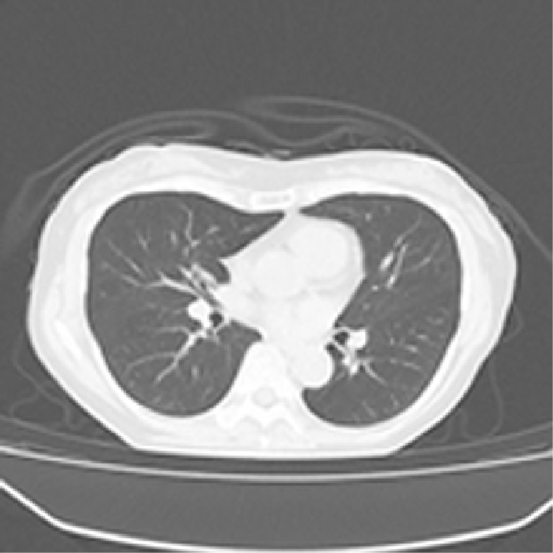 低線量肺CT(1/5 線量）